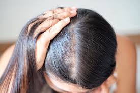 is hair loss only for older women