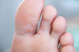 athletes foot treatment moore foot