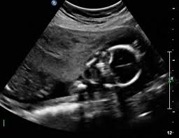 Fetal Ultrasound Image Gallery Fetal Pictures Of Ultrasound