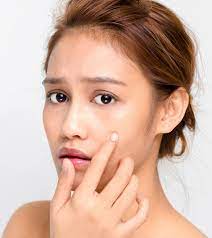 can mederma be used to treat acne scars