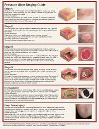 Pressure Ulcer Guide Pressure Ulcer Pressure Ulcer