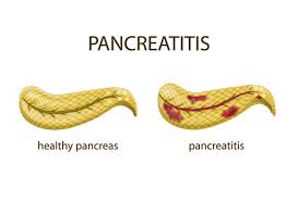 pancreais gastroenterology san antonio