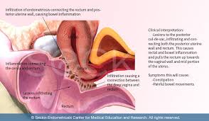 bowel endometriosis symptoms