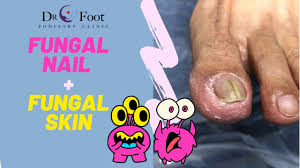 fungal nail infection toenail fungus