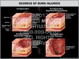 Degrees Of Burn Injuries