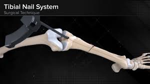 tibial nail system standard surgical
