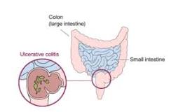 Image result for icd 10 code for colonic ulcer