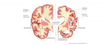 Eventually, alzheimer's disease affects most areas of your brain. Alzheimer Ursachen Symptome Verlauf Pflege De