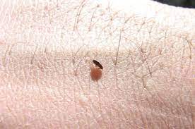 fleas bedbugs the spiderman marlborough