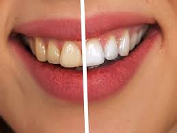 Years ago i decided to take the fast track to a there is much advice on how to whiten your teeth in the natural health world. Whitening Teeth Naturally Home Tips For The Perfect Pearly Whites