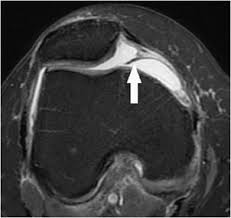 Along the posterior portion of the muscle (yellow arrows), there is a flat area of tendon originating from the knee. Knee Mri Radiology Key