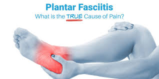 plantar fasciitis what is the true