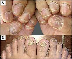 twenty nail dystrophy with fractional