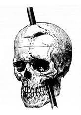 Case Studies  What is a case study  A case study is a detailed     The Famous Case of Phineas Gage s Astonishing Brain Injury