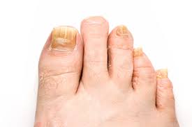 toenail discoloration from toenail fungus
