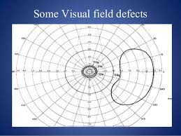 Visual Field Testing And Interpretation