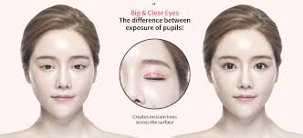 'without the plastic surgery, korean women are very diverse looking and easily can be told apart. Korea Eye Plastic Surgery Large Eyes Effect By Valerie Park Medium