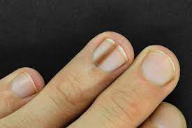 black line on nail causes treatment