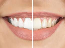 ayurvedic teeth whitening powder