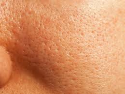 how to get rid of open pores 10