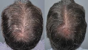 Regardless of what the med label states, its more common than not, if you join any of the contrave facebook pages, you'll see how common it is. Does Prp For Hair Loss Work Hair Loss Cure 2020