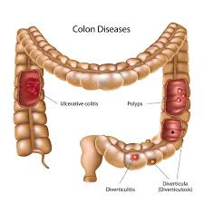 colon cancer and ulcerative colitis
