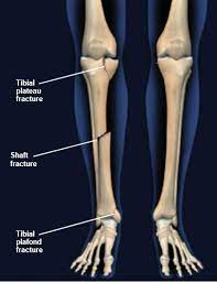 tibial fractures central coast