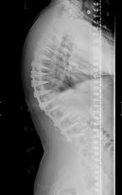 Scheuermann's kyphosis involves wedging of vertebrae (generally thoracic) which creates a kyphotic deformity >45 degrees. Scheuermann S Kyphosis Spine Orthobullets
