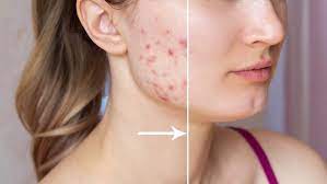 3 nonsurgical acne treatments for acne