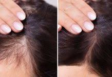 age hair loss thinning treatment