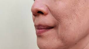 treatments for wrinkles above the lips