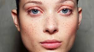 freckle enhancement chicago permanent