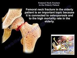 fem neck fracture in the elderly