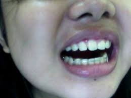 How long are retainers needed? Will Retainers Shift Teeth Back Into Place 6 Months After Braces Photo