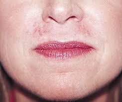 hypertrophic lip scar following