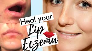 lip eczema treatment