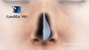 signs you may have a deviated septum