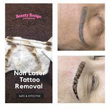 non laser tattoo removal