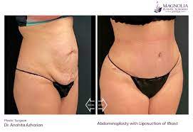 fat removal body contouring