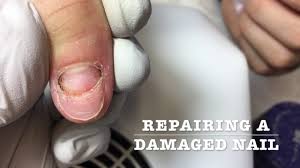 repairing a damaged nail bed