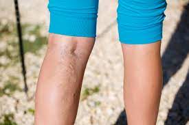 how to cover up varicose veins leaftv