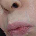 blue vein above upper lip how to