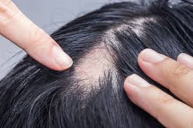 alopecia areata causes diagnosis