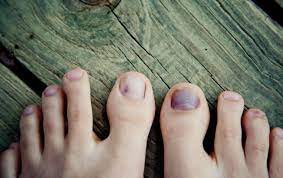 why runners toenails fall off 4