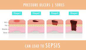 physical therapy guide to bed sores