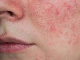 lupus rash vs rosacea what s causing