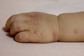 rashes in es and children nhs