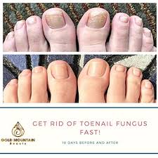 strongest nail fungus treatment