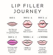 swelling last after lip filler