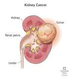 what-does-kidney-cancer-do